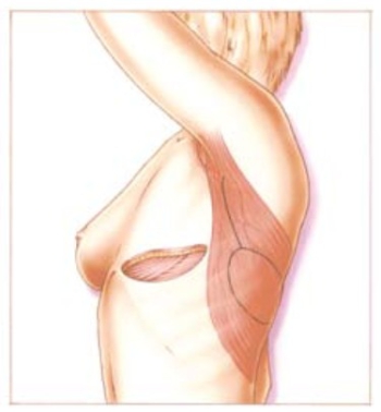 Huid- en spierweefsel van de rug voor de reconstructie