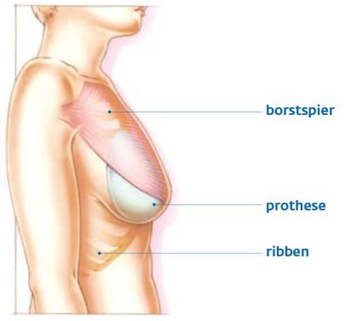De prothese wordt operatief onder de borstspier geplaatst. De borstspier bedekt de prothese voor tweederdedeel aan de bovenkant.